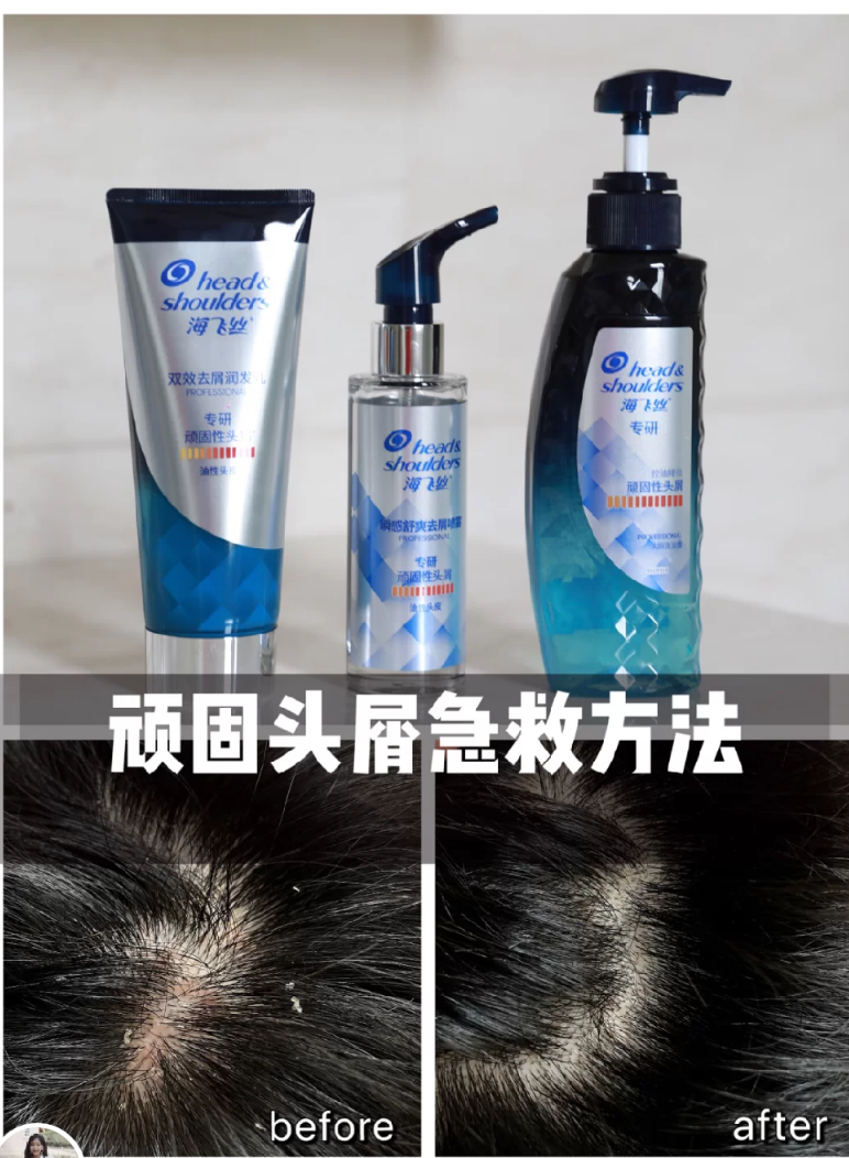 热门去屑洗发水排行榜！头发瘙痒、出油、头屑严重？快看看
